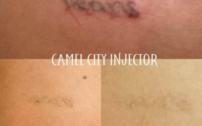 Black Ink Tattoo Removal in Winston Salem