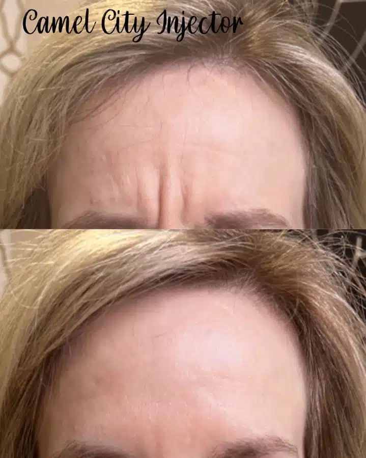 botox injections in winston salem nc