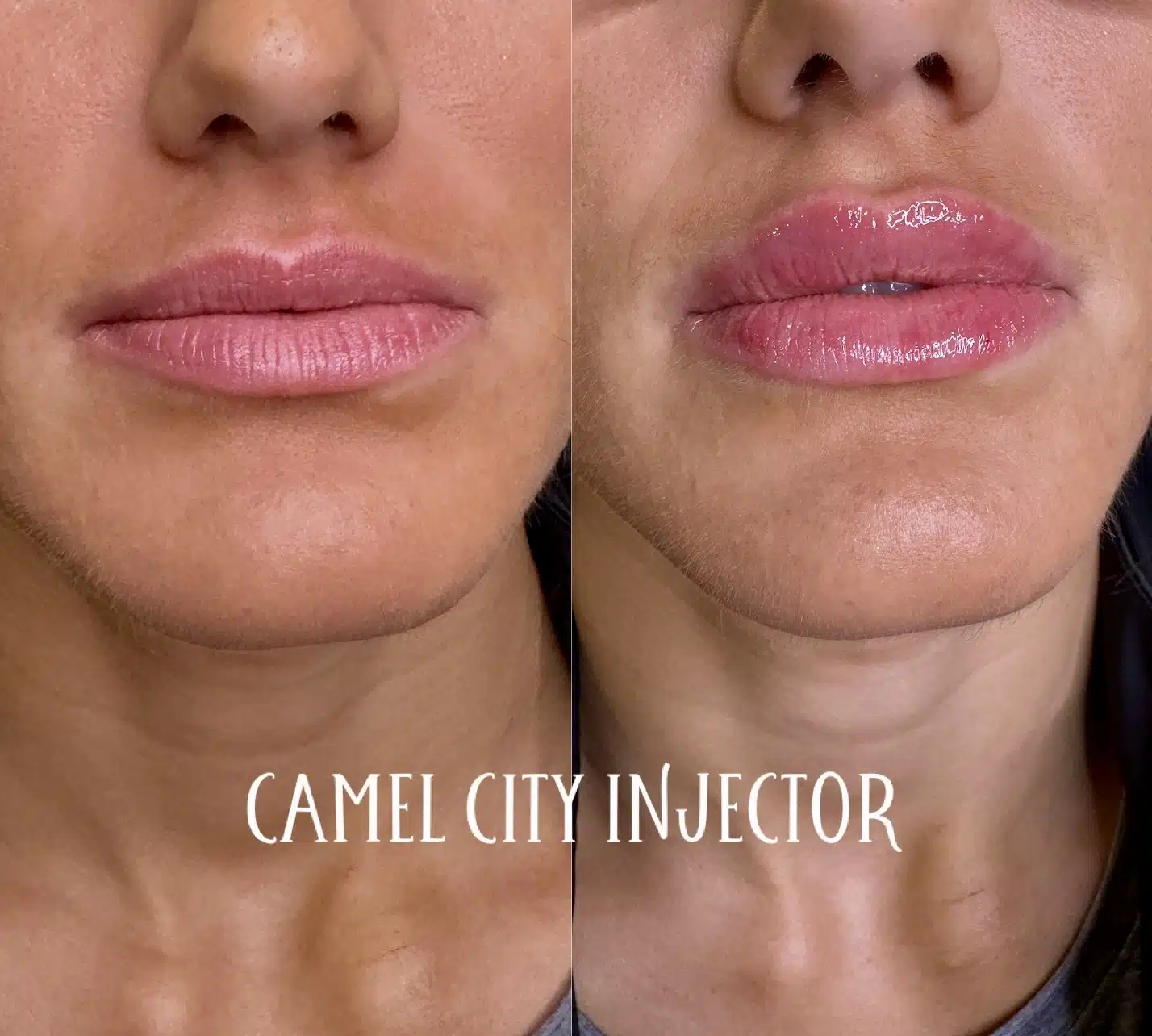 Lip area results at Camel City Injector near Winston-Salem Lip area results at Camel City Injector near Winston-Salem
