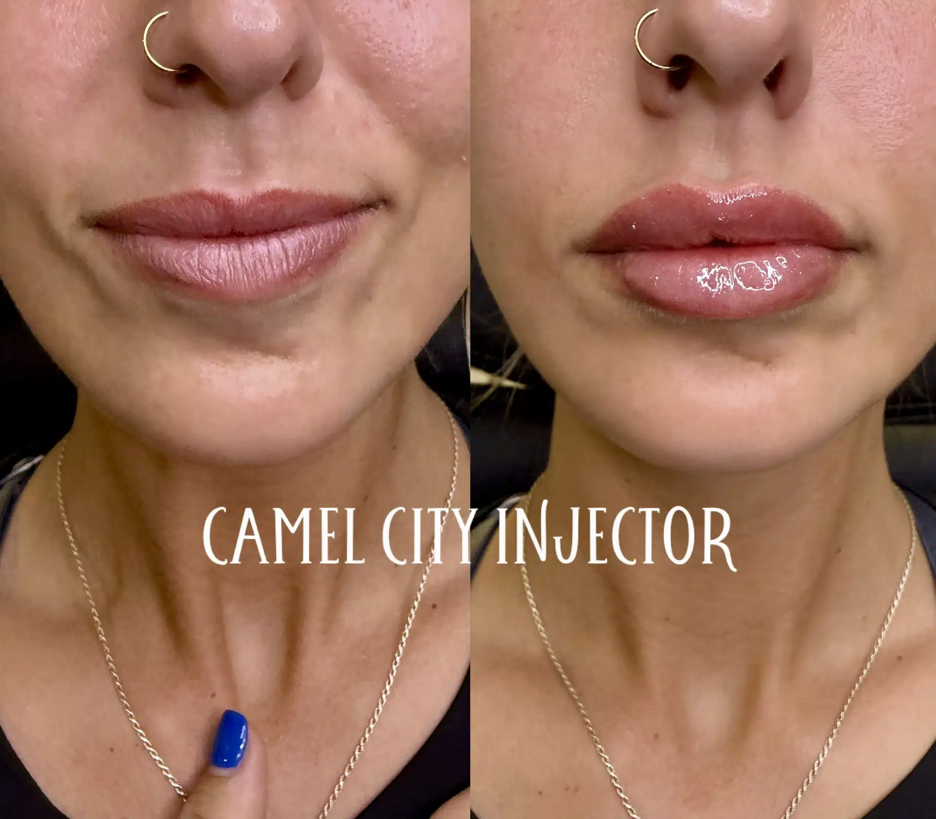 Lip area before and after at Camel City Injector Lip area before and after at Camel City Injector