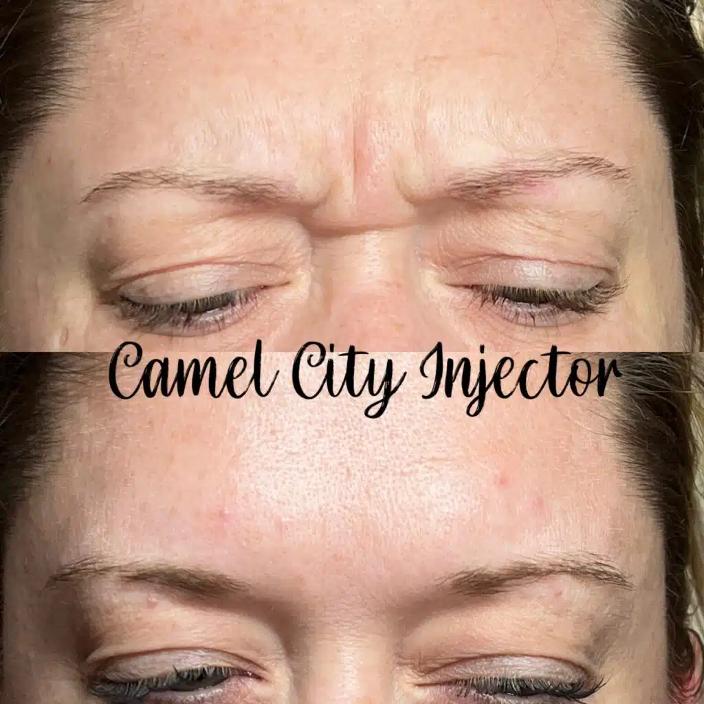 Botox Treatments Benefits and Risks