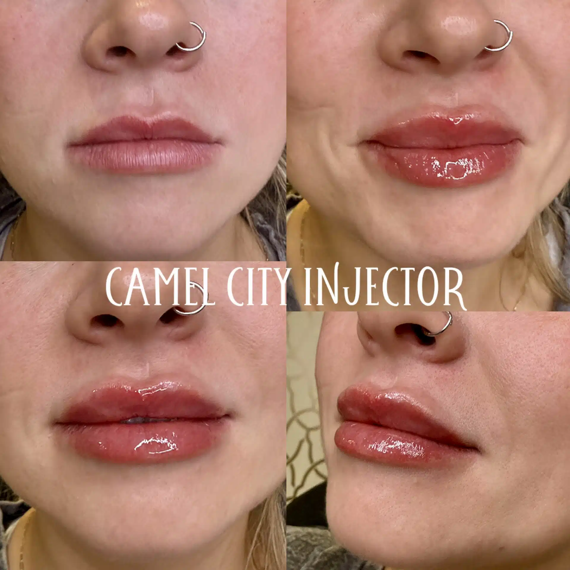 Upper lip results at Camel City Injector Upper lip results at Camel City Injector