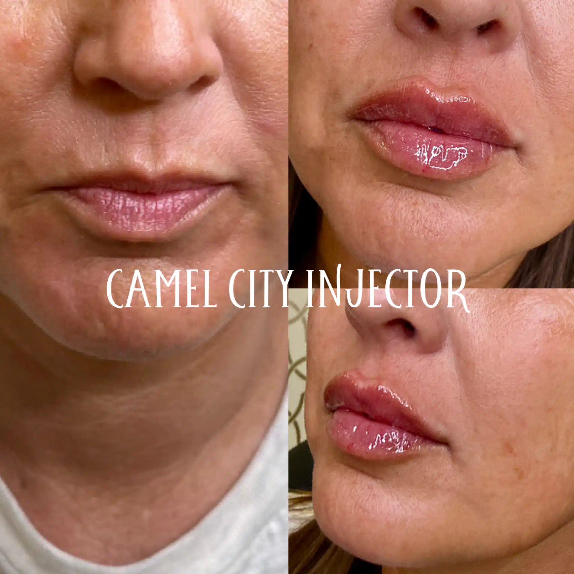 Lip treatment results at Camel City Injector Lip treatment results at Camel City Injector