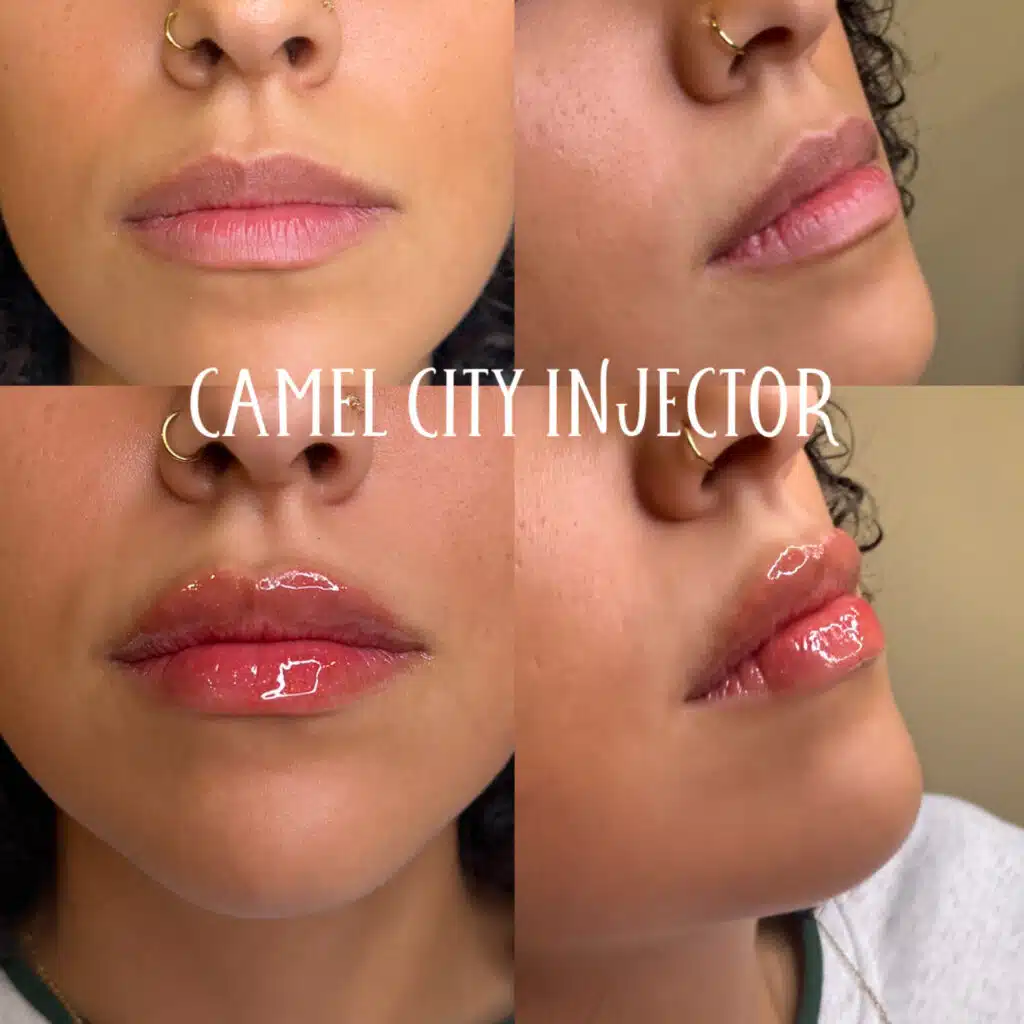 Upper lip area treated at Camel City Injector