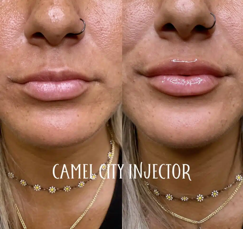 Lip and smile area results at Camel City Injector