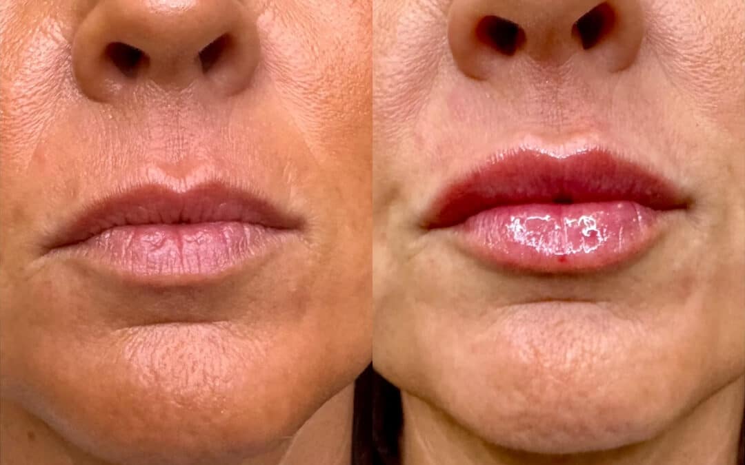 The Russian Technique: Lip Filler Near Me