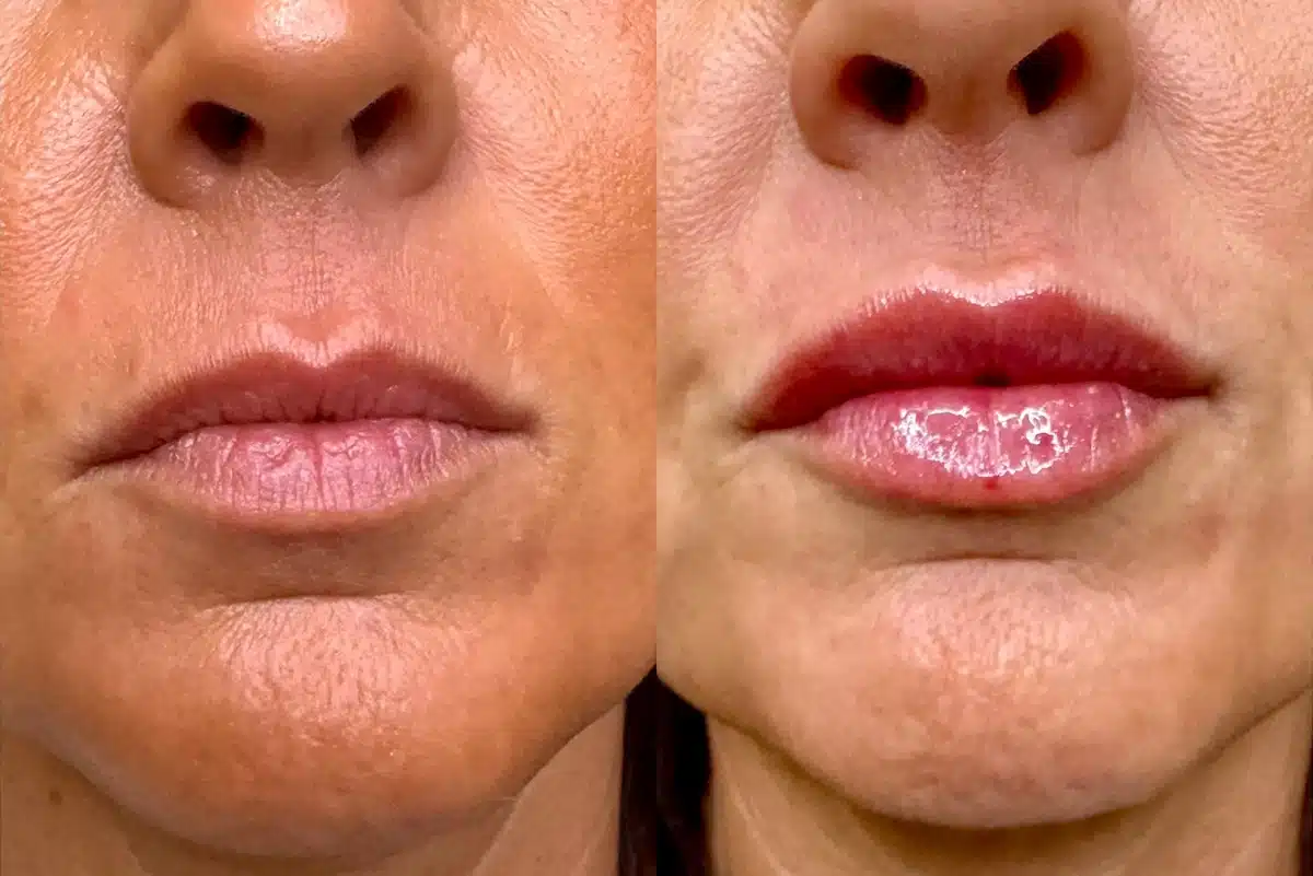 Lip Filler