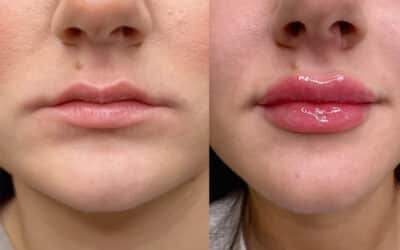 Lip Flip vs Lip Filler in Winston Salem