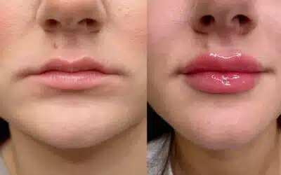 Lip Flip vs Lip Filler in Winston Salem