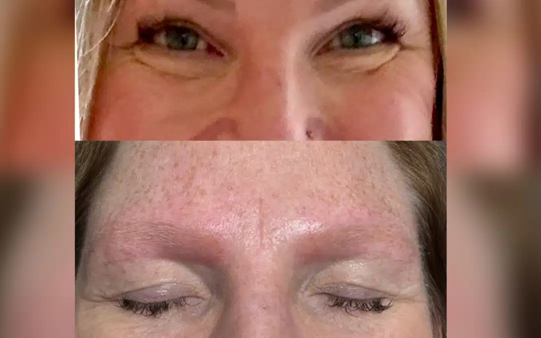Microblading Removal