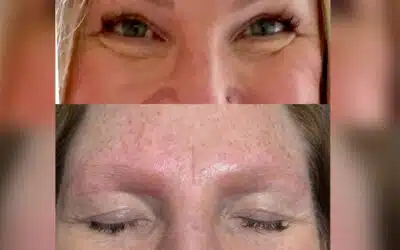Everything You Need to Know About Microblading Removal Near Me