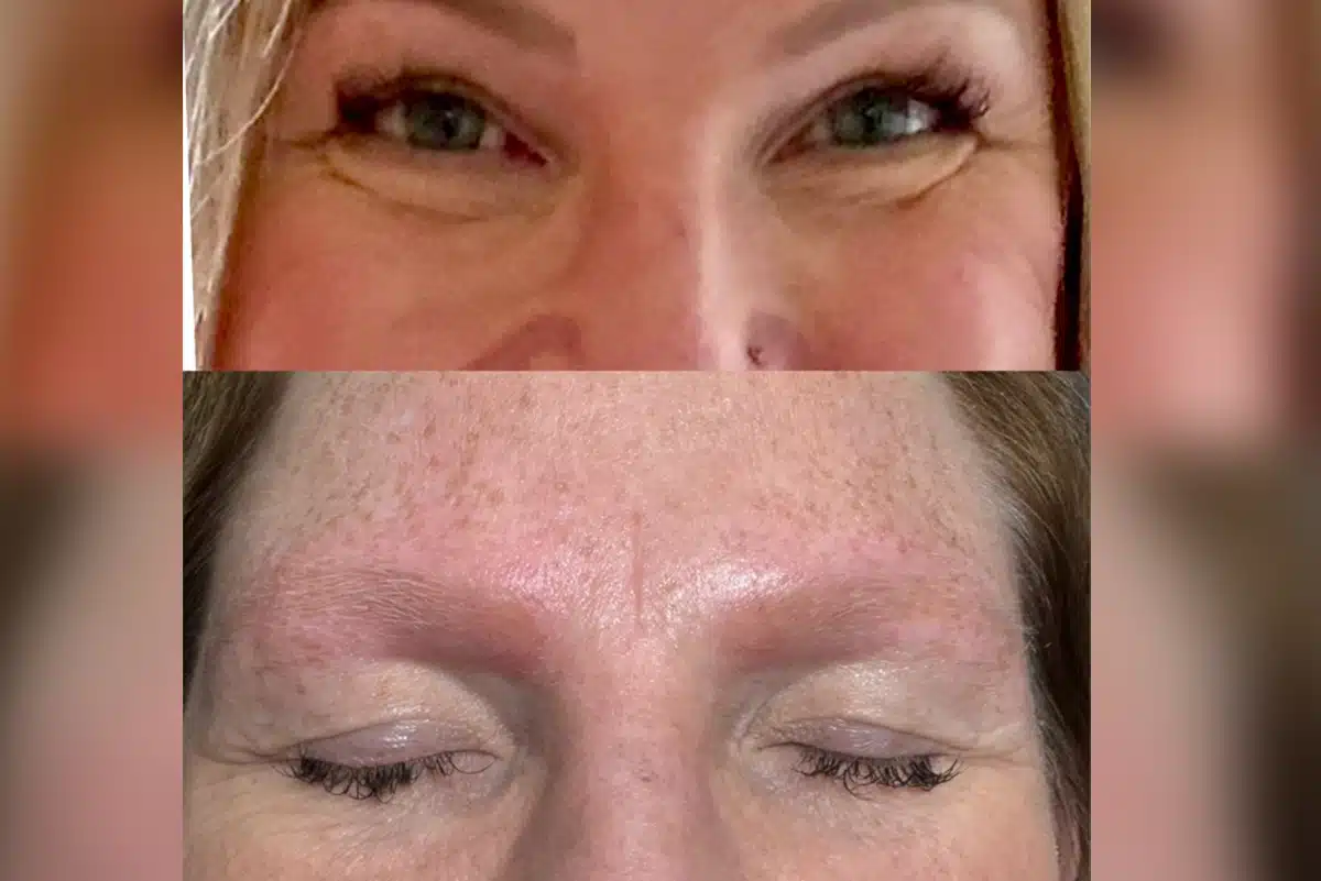 Microblading Removal Microblading Removal