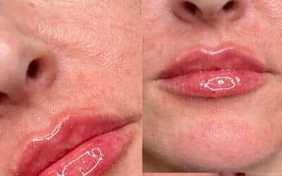 Perfect Balance with Lip Filler in Winston Salem