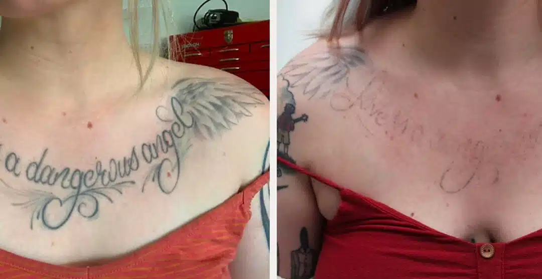 Tattoo Removal: Restore Your Skin’s Natural Look in 6–8 Treatments