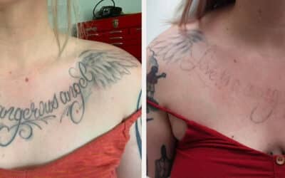 Tattoo Removal: Restore Your Skin’s Natural Look in 8-10 Treatments
