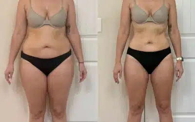 Tirzepatide vs Semaglutide in Winston Salem