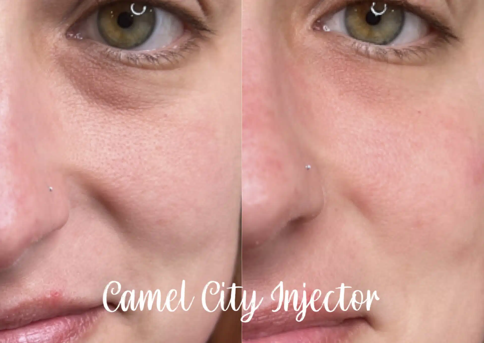 Full‑Face Rejuvenation with Dermal Fillers