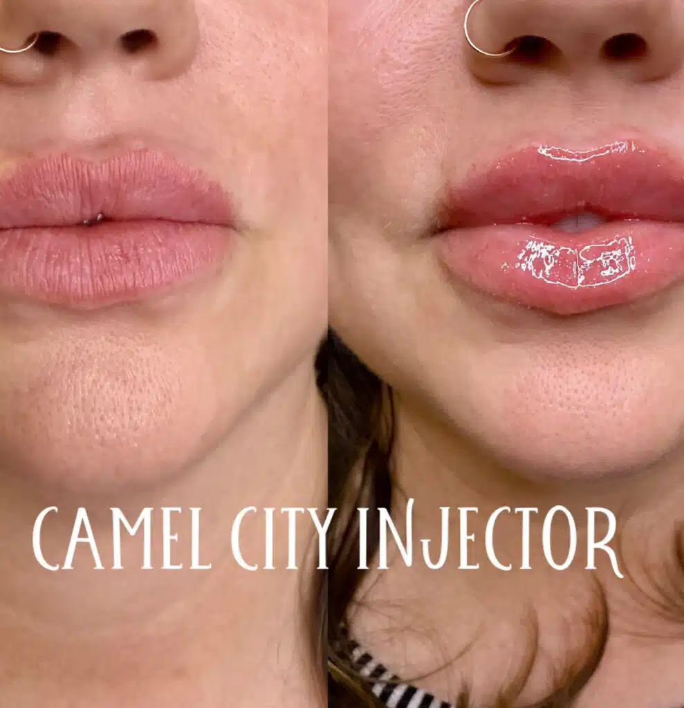Certified lip filler injector near greensboro