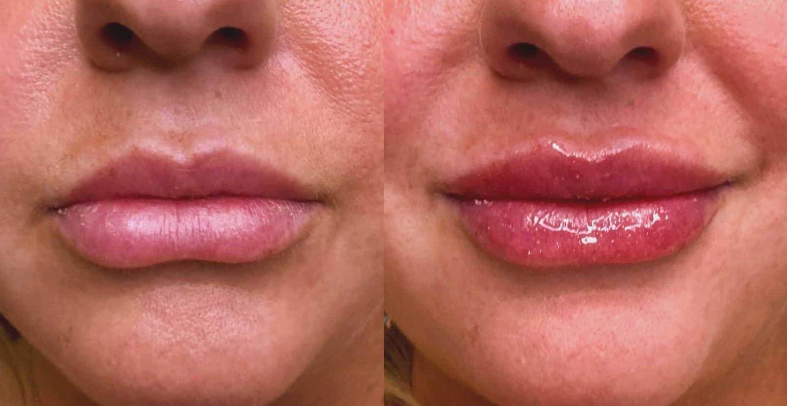 Lip Filler