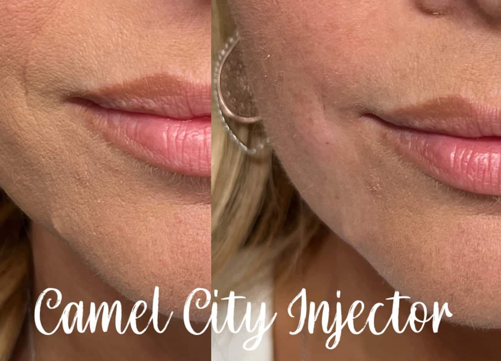 Dermal Fillers and Botox Dermal Fillers and Botox