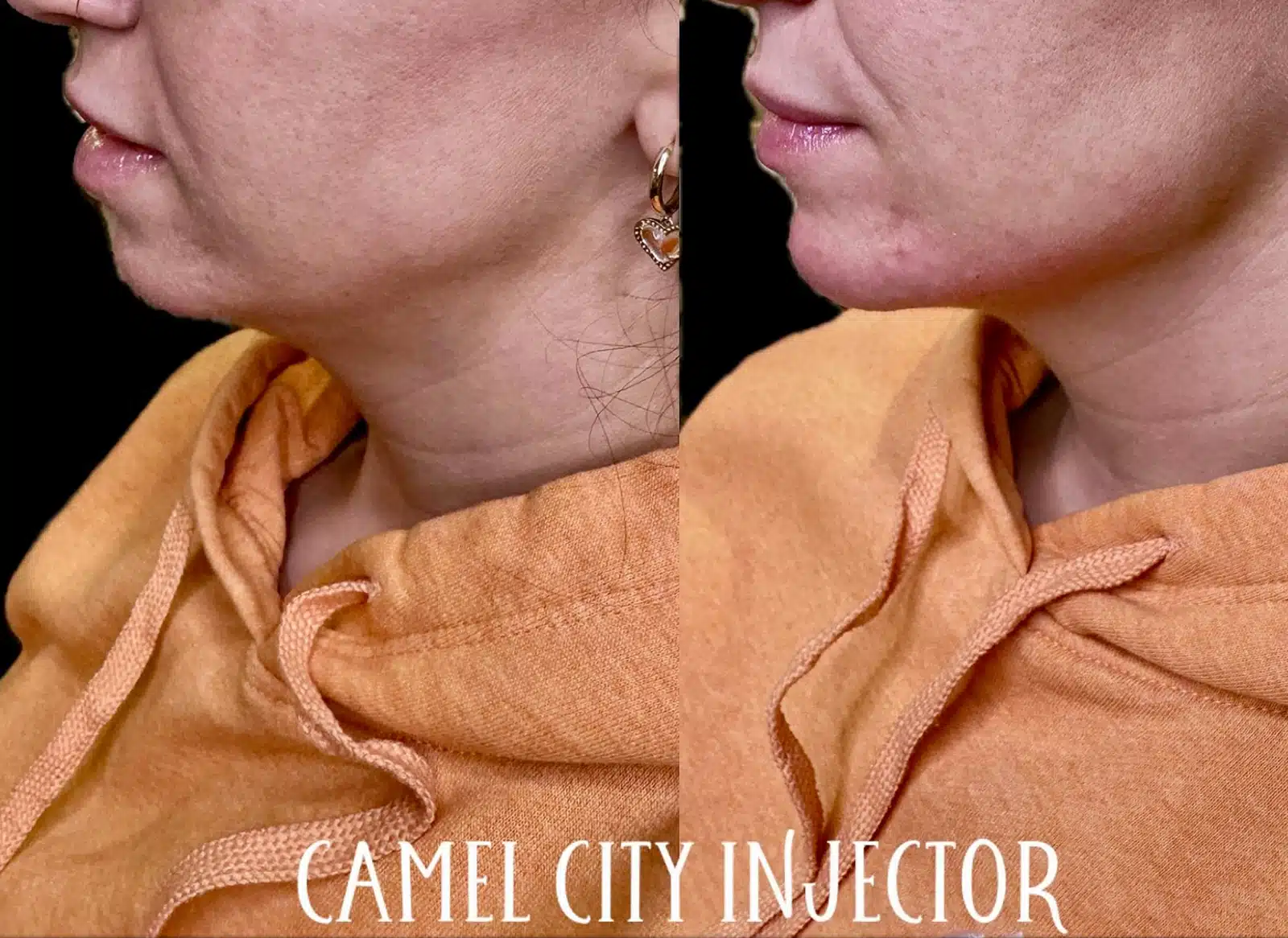 Full‑Face Rejuvenation with Dermal Fillers