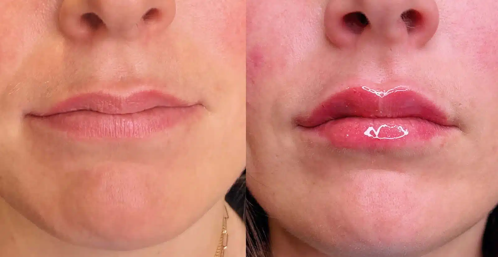 Camel City Injector for Lip Filler