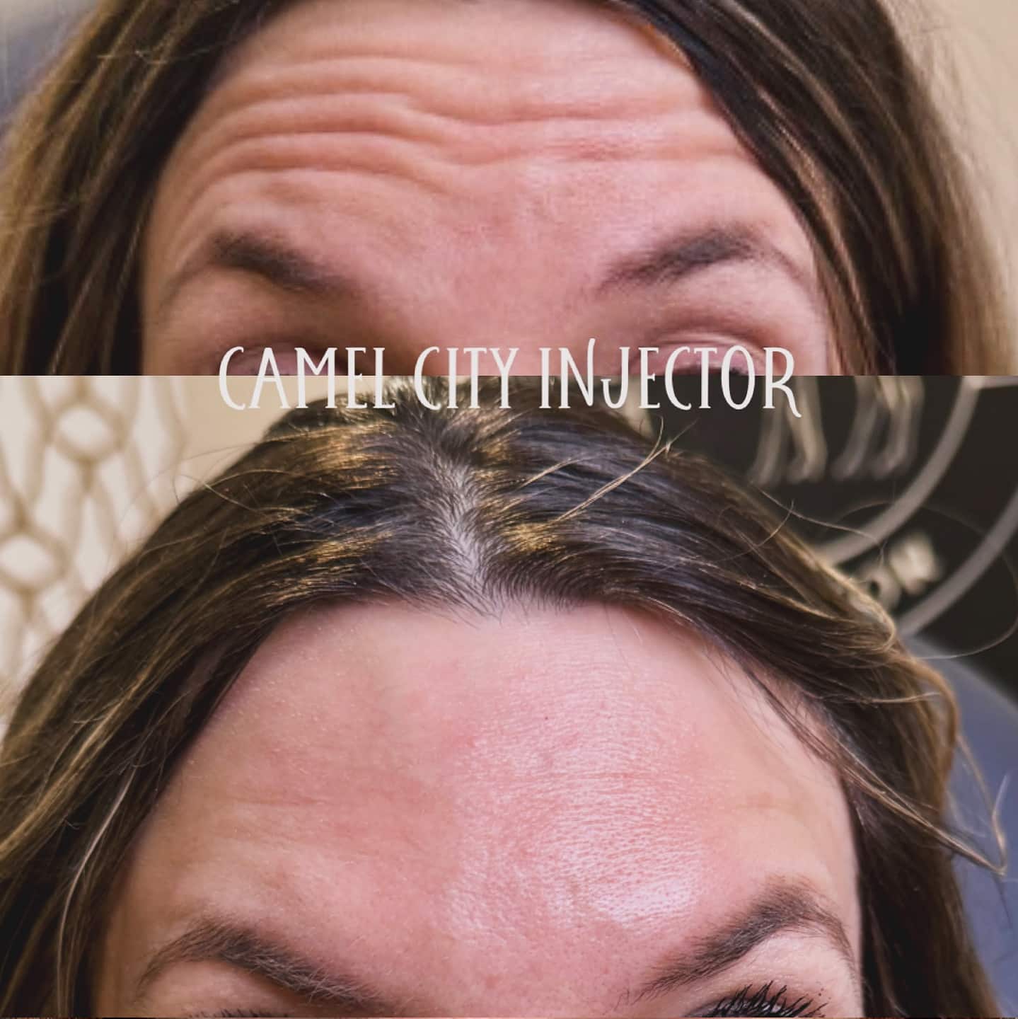Botox Treatment Winston Salem