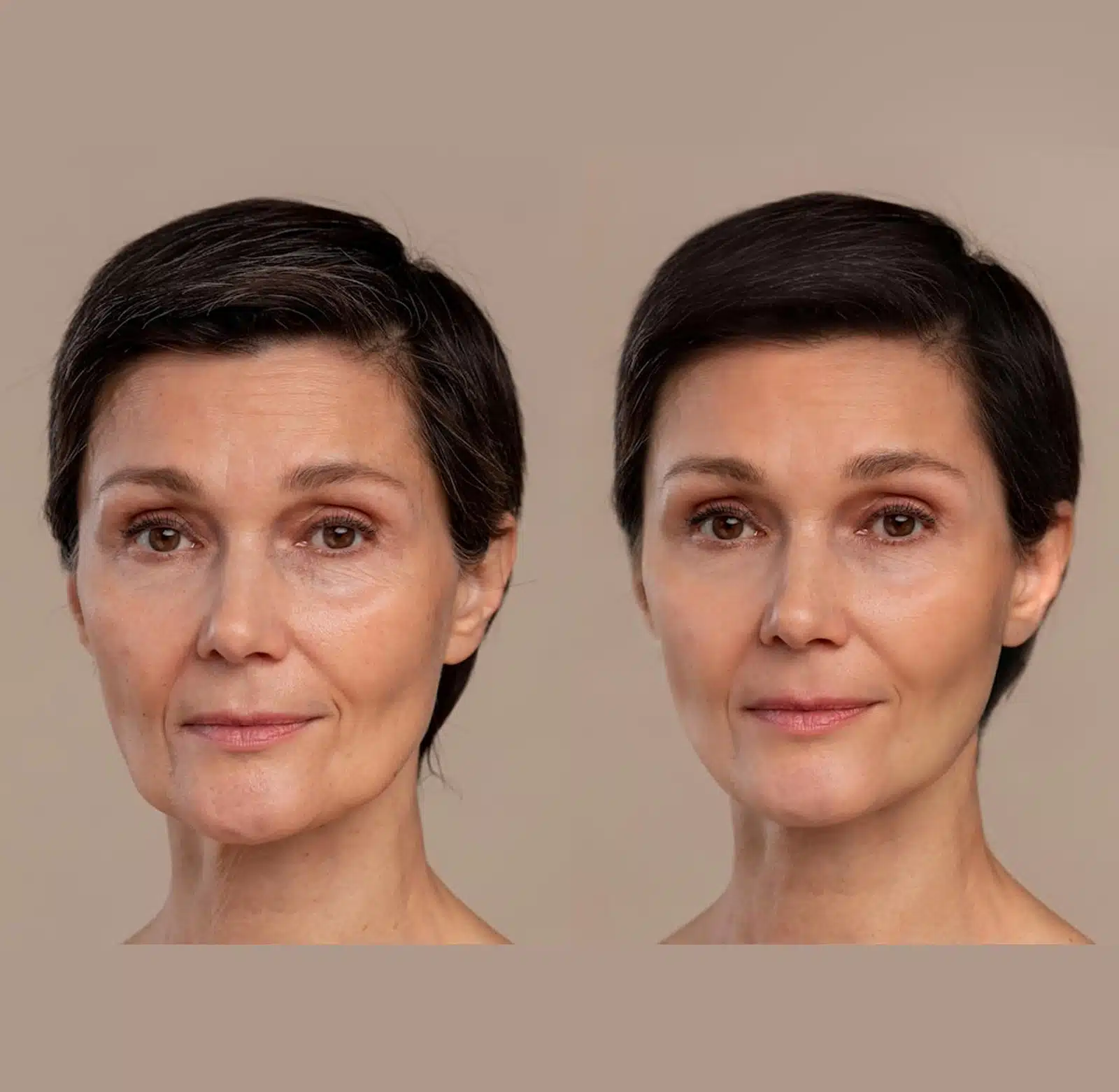 Botox Is a Leading Anti-Aging Solution