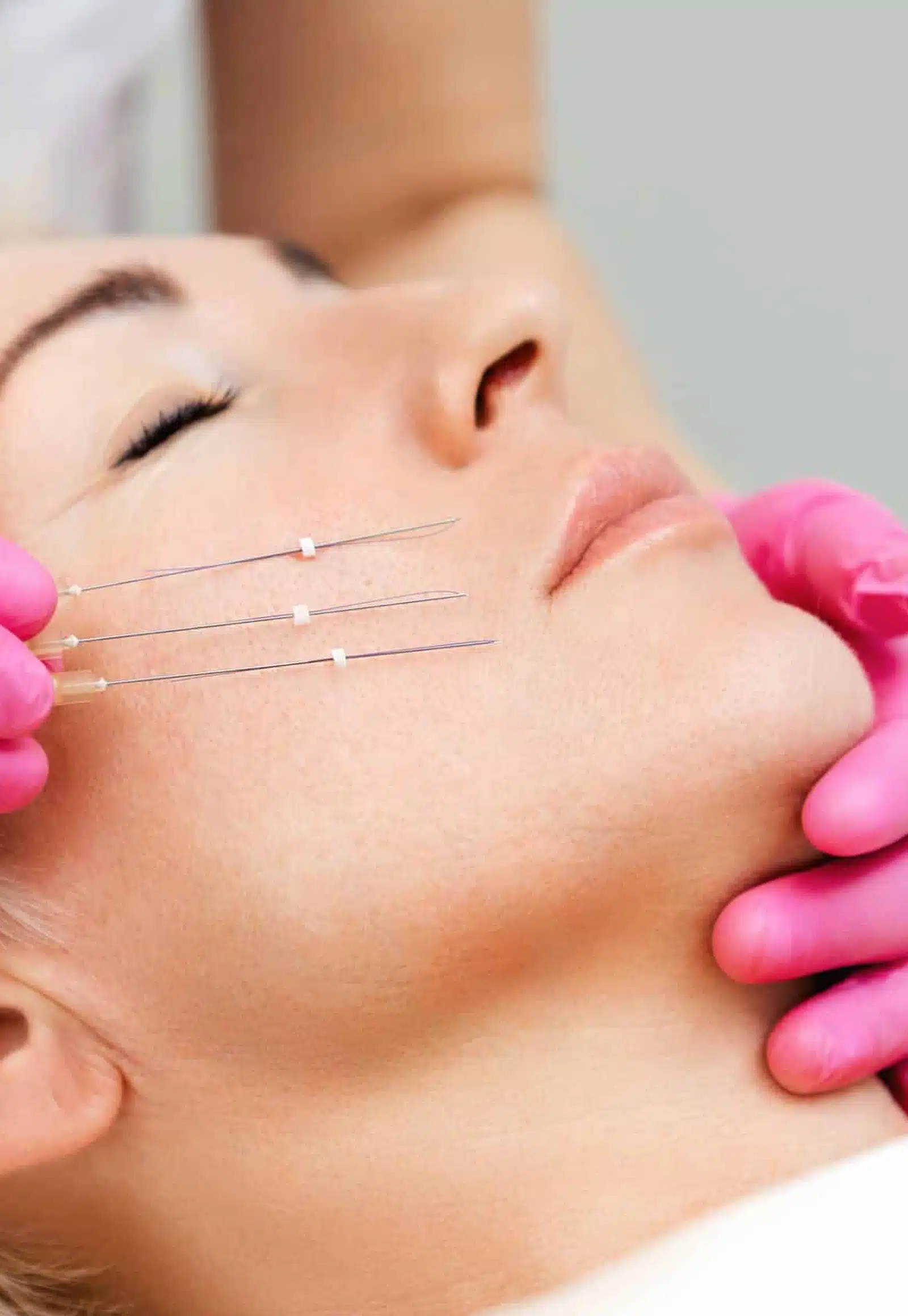 Expect During a Thread Lift Procedure