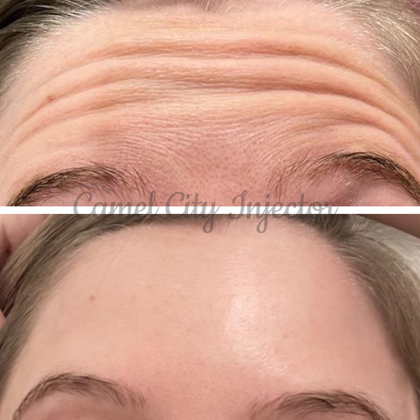 Botox Treatment Winston Salem