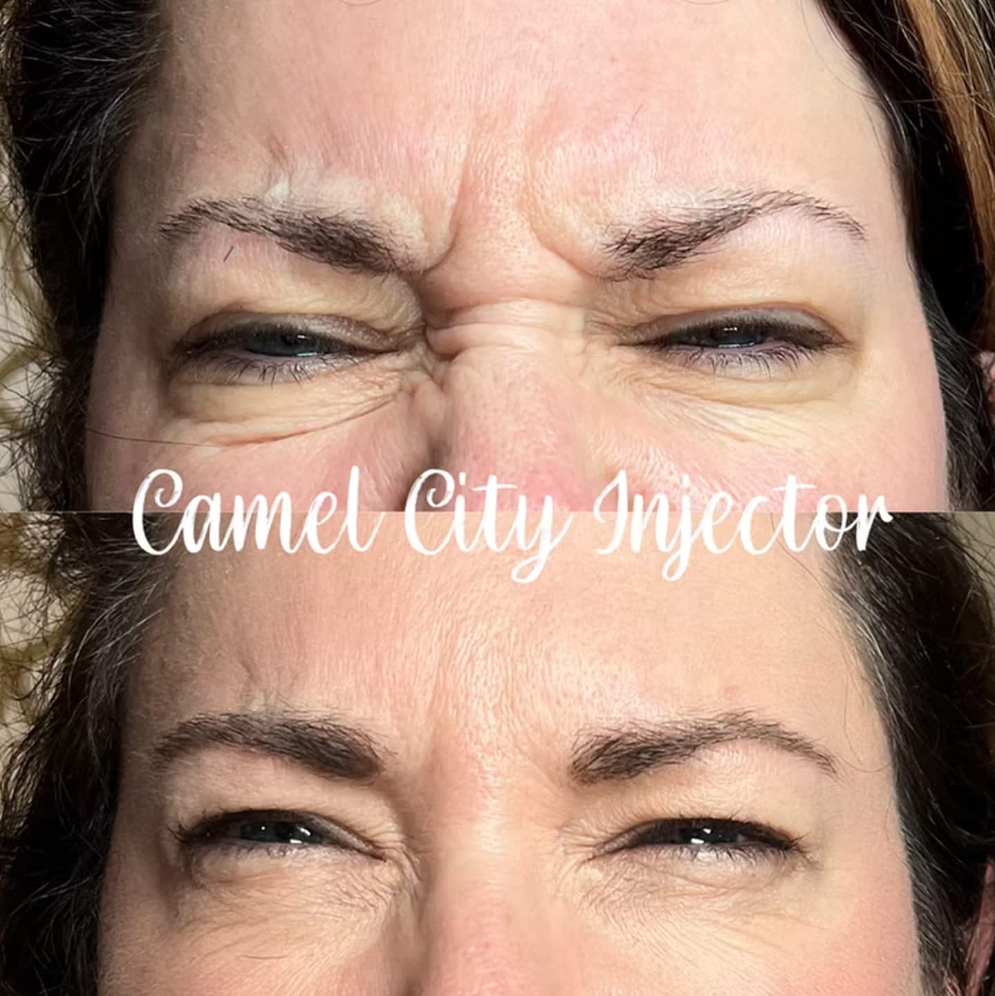 Botox Treatment Winston Salem