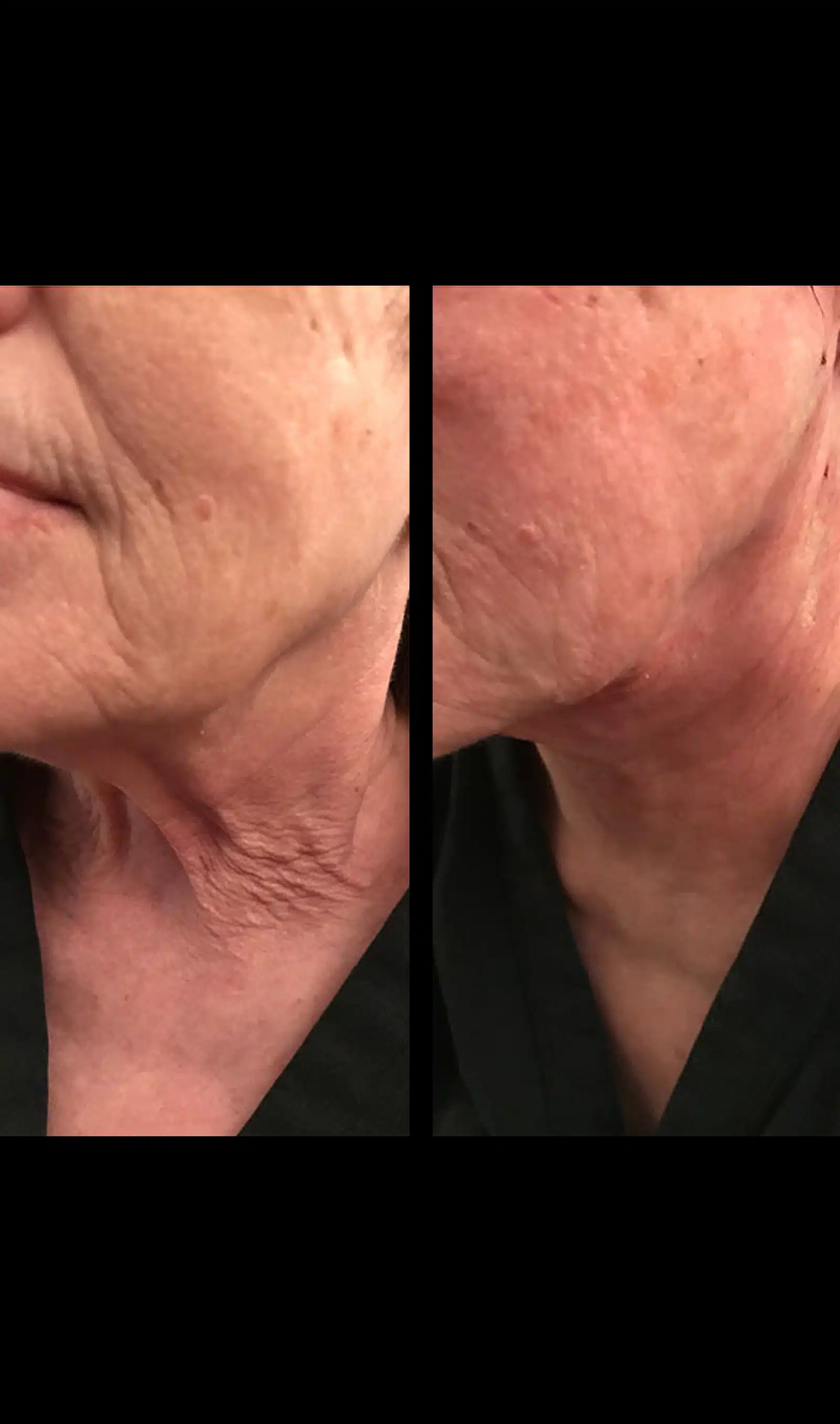 Full‑Face Rejuvenation with Dermal Fillers
