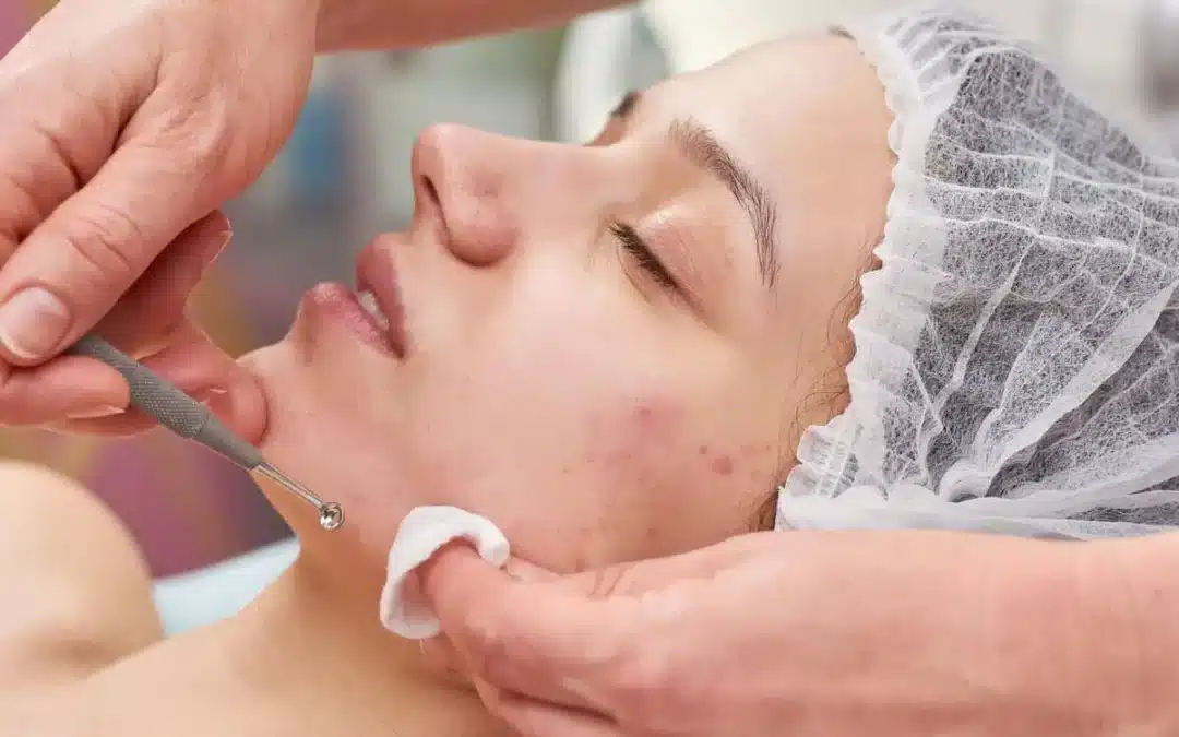 Clear & Confident: Your Ultimate Guide to Acne Scar Treatments in 2026