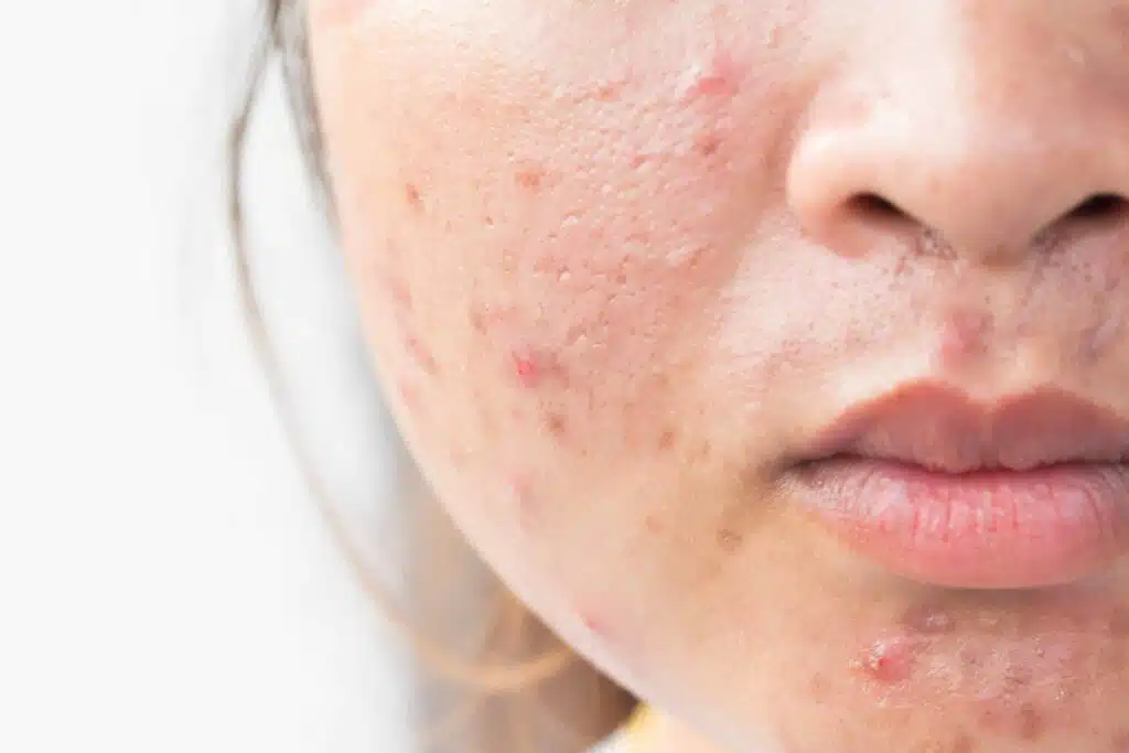 Acne Scars Treatment Guide 2026