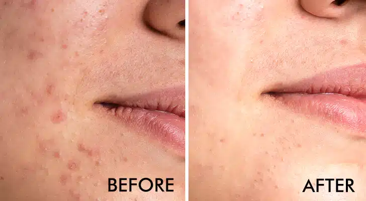 Acne Scars Treatment Guide 2026