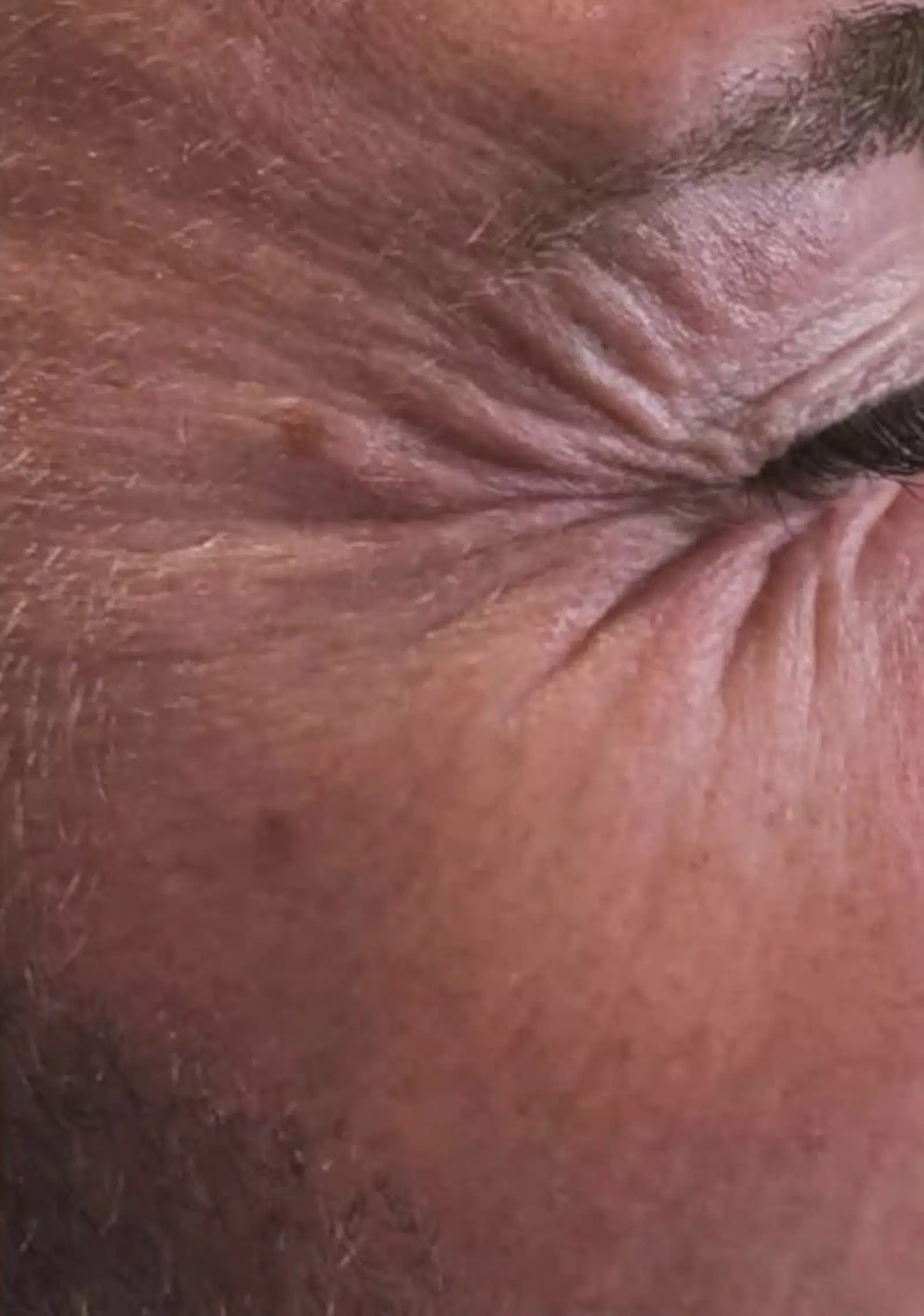 Benefit from a Thread Lift Benefit from a Thread Lift