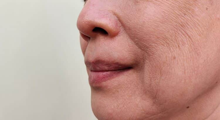 Best Treatments for Smile Lines Without Surgery