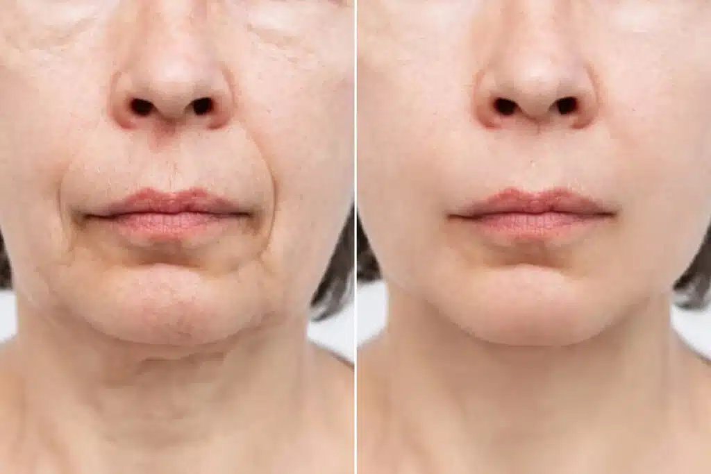 Best Treatments for Smile Lines Without Surgery