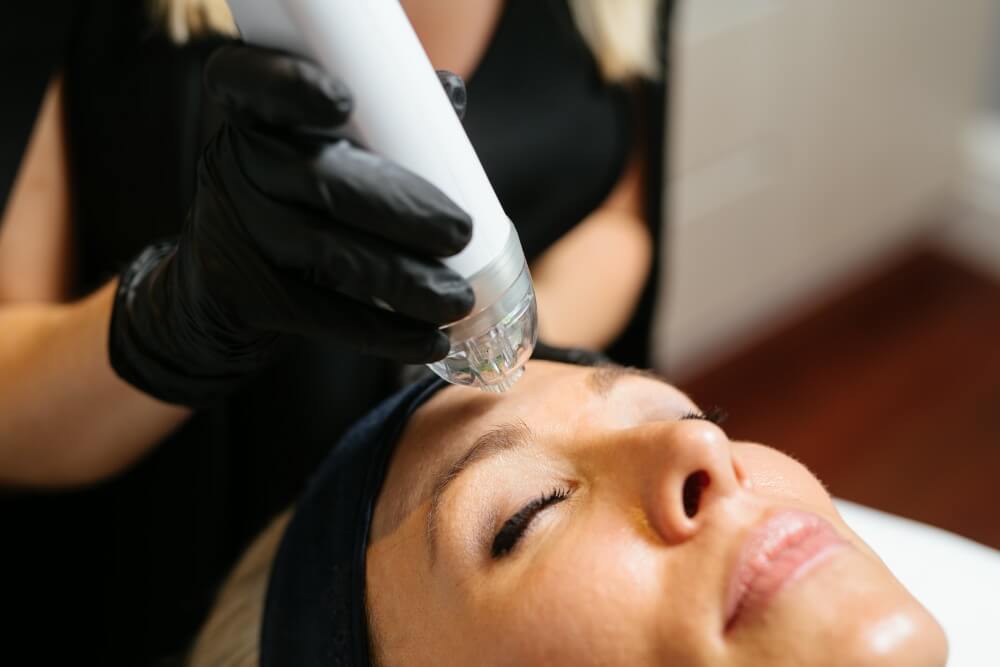 Erbium Laser vs RF Microneedling Winston Salem