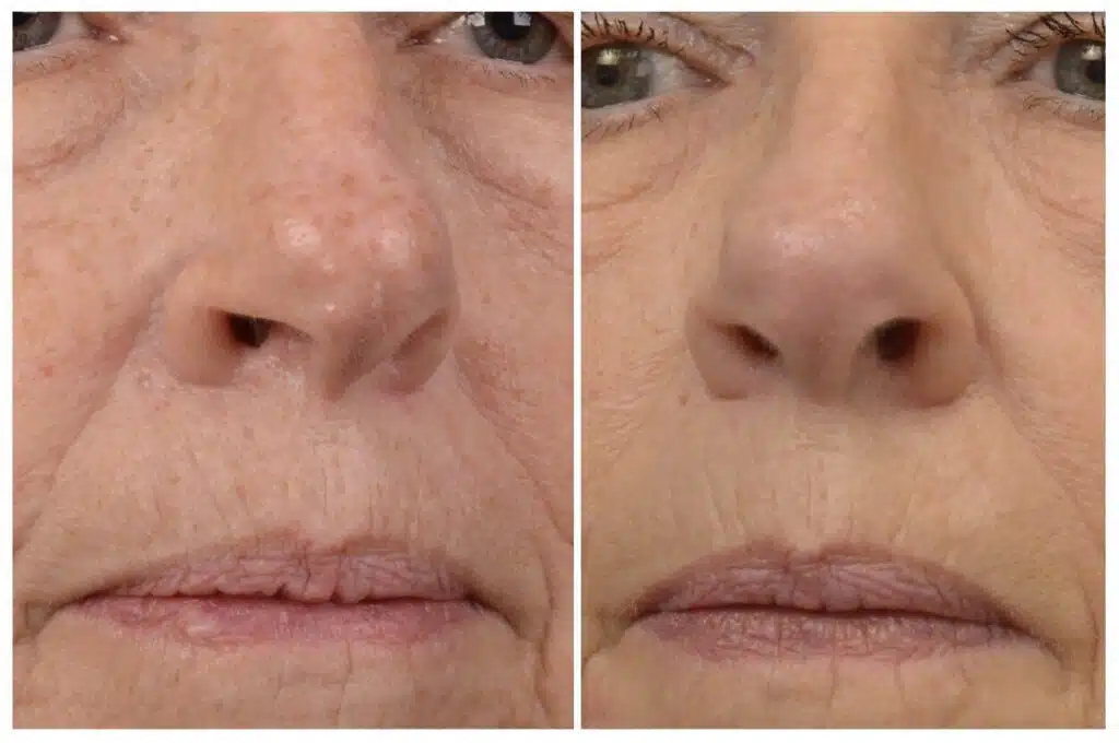 Erbium Laser vs RF Microneedling Winston Salem