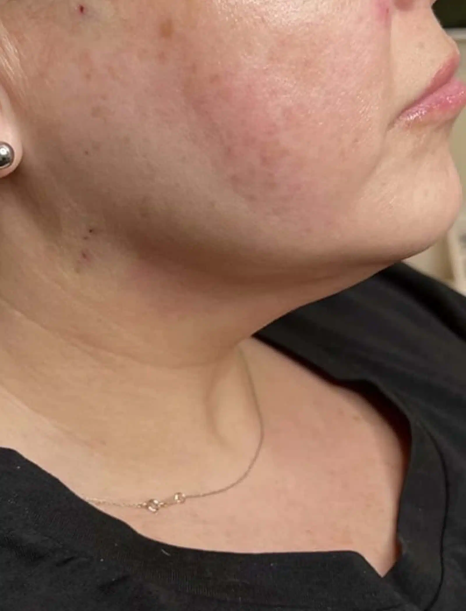 Expect During a Thread Lift Procedure