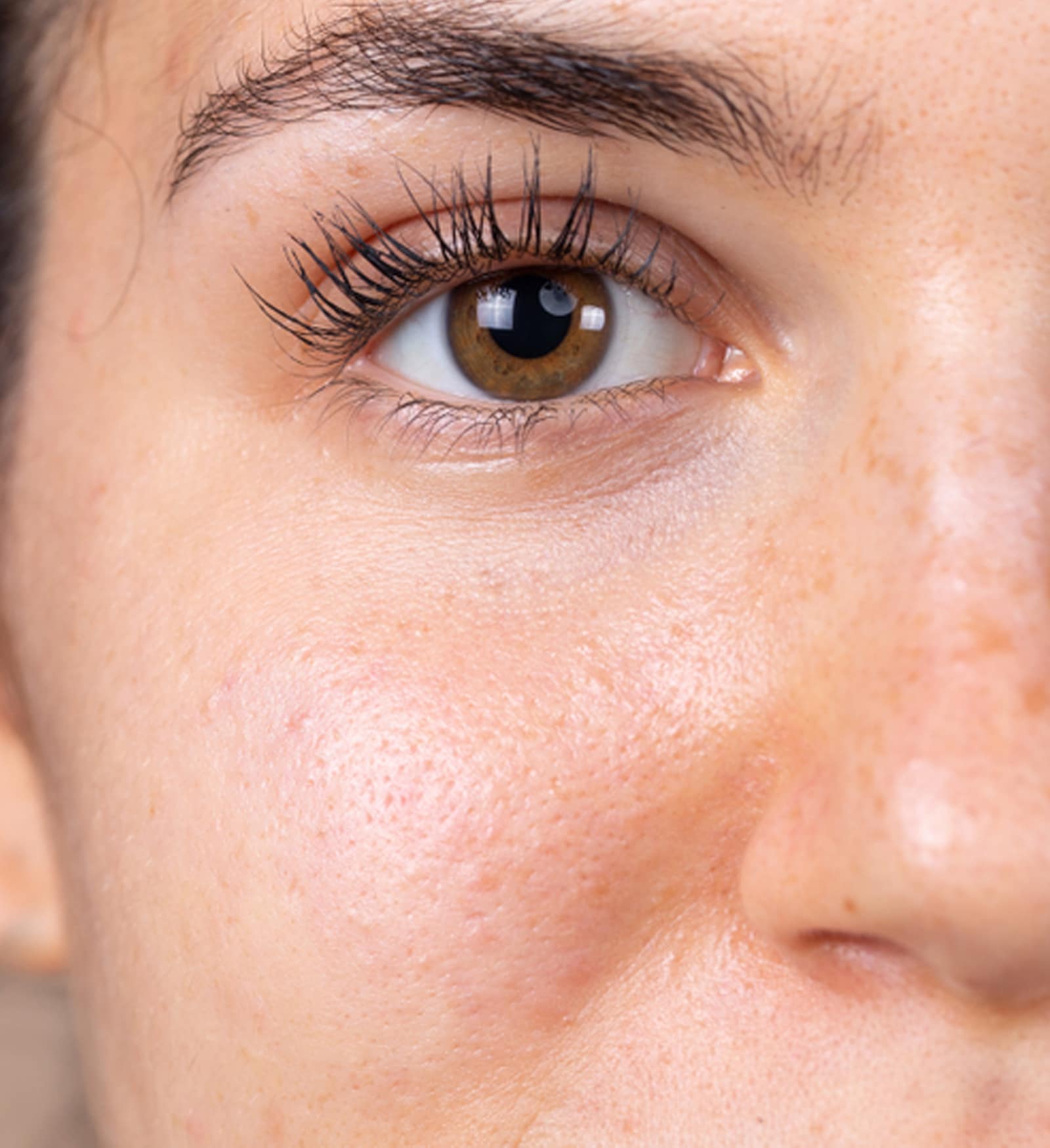 Eye Filler to Other Options Eye Filler to Other Options