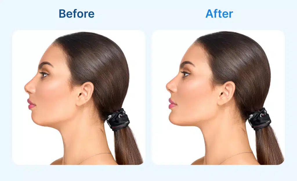 Jawline Filler Benefits and Side Effects NC