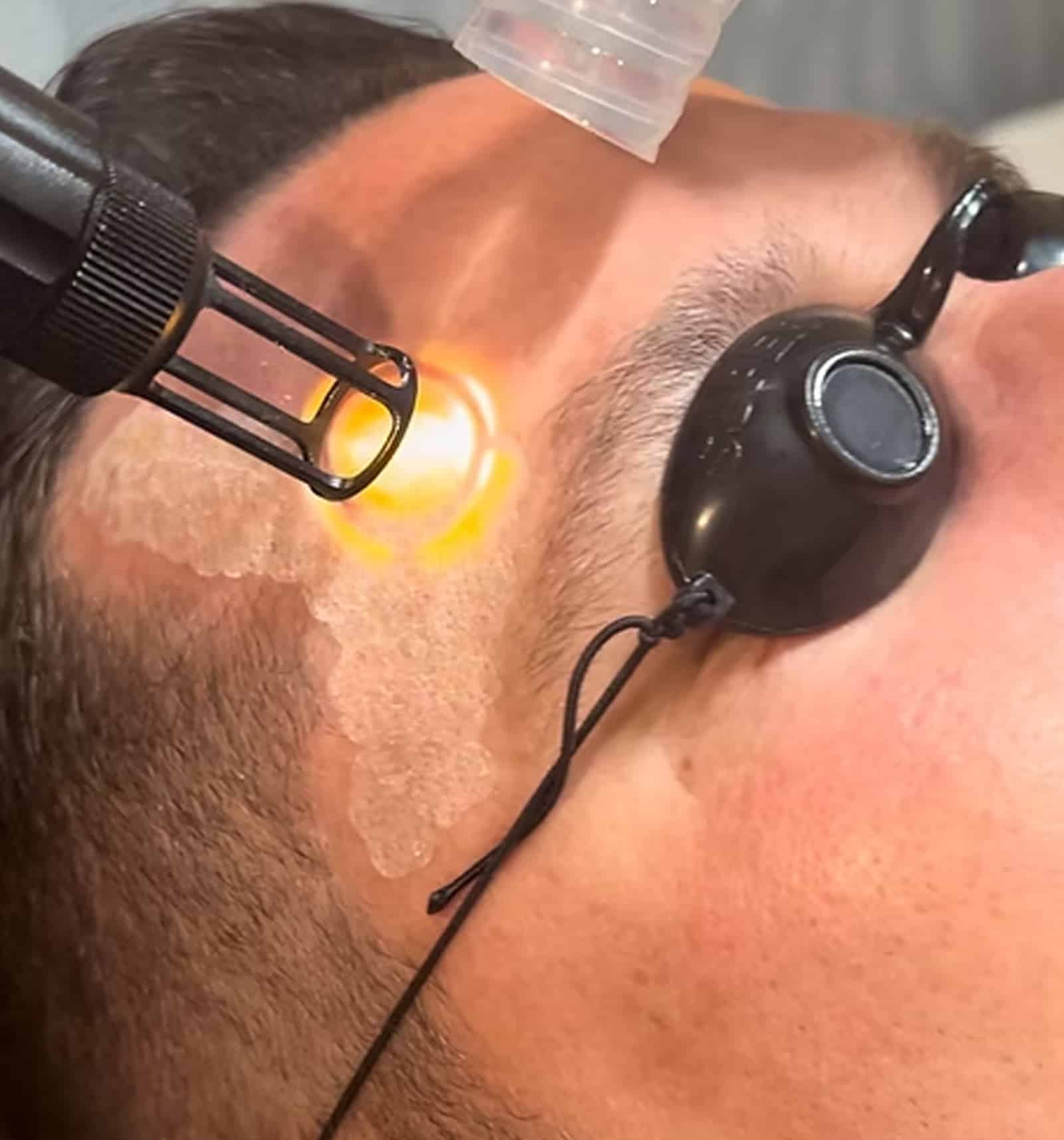 King, NC Clients Trust Laser Skin Treatments Chemical Peels Treat
