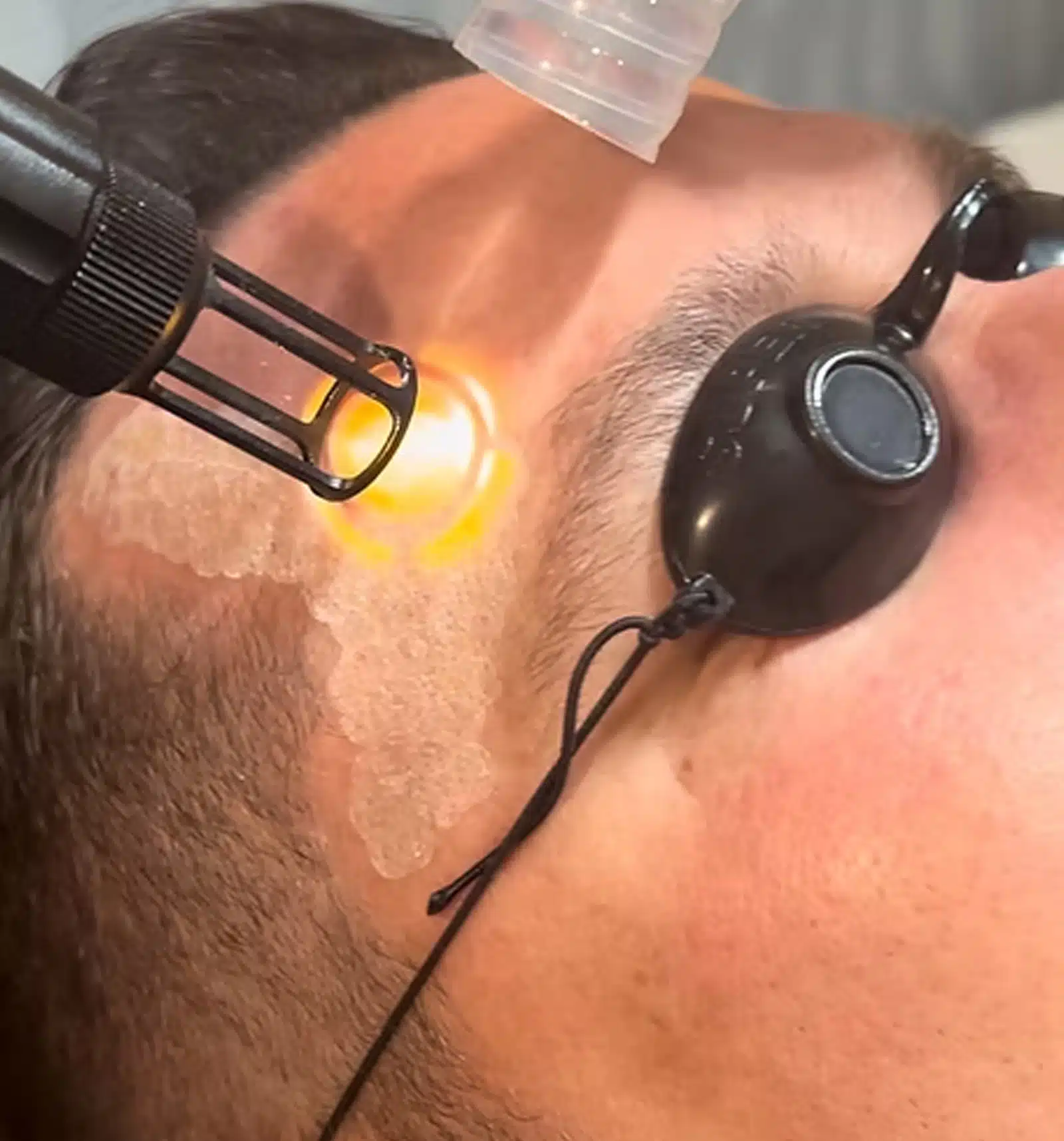 Chemical Peels Treat