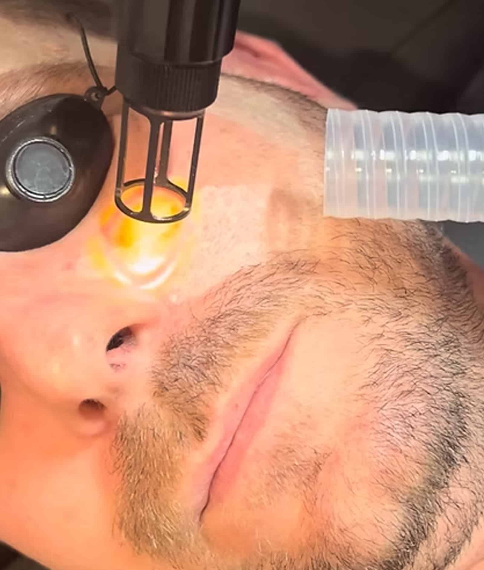 Laser Skin Rejuvenation Laser Skin Rejuvenation