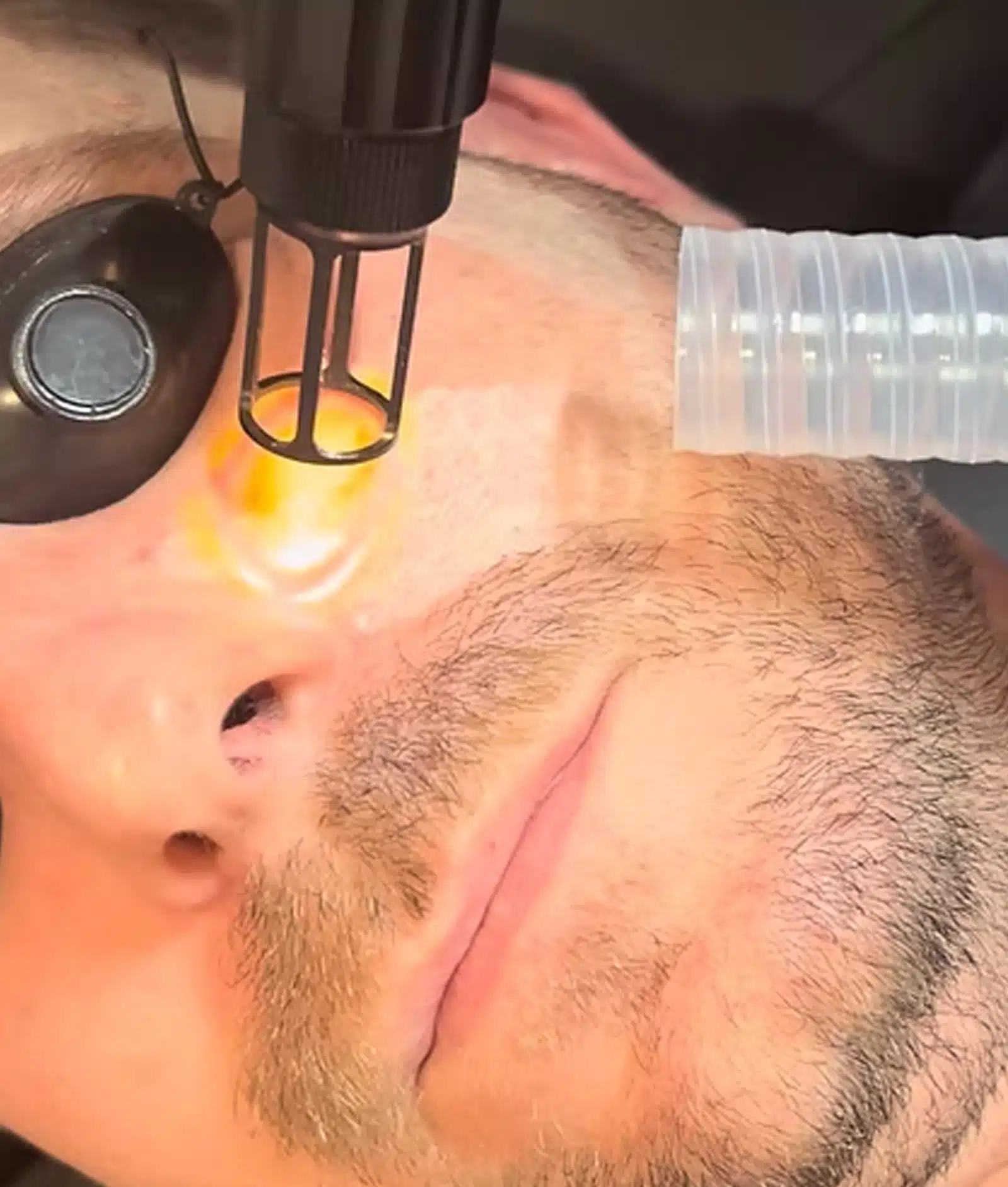 Laser Skin Rejuvenation