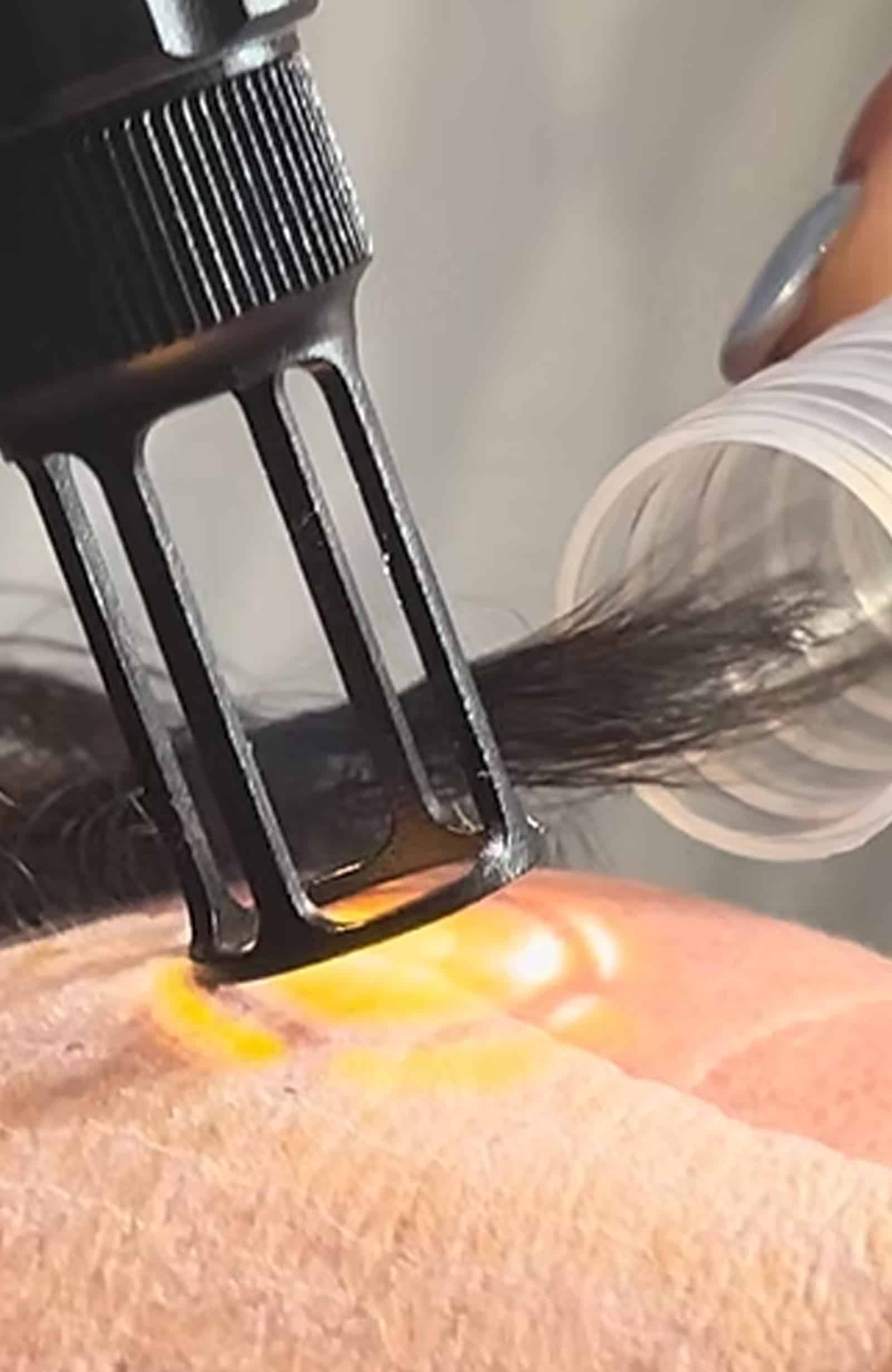 Laser Skin Treatments Chemical Peel Appointment