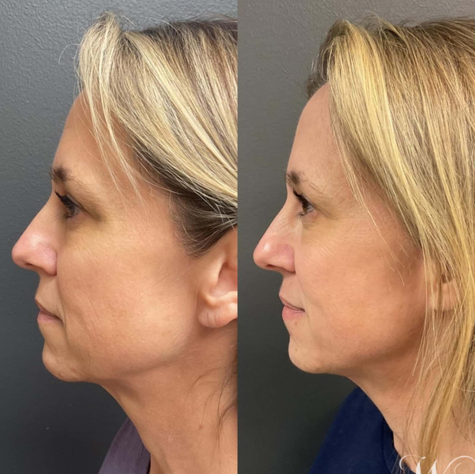 Mild redness or swelling Mild redness or swelling