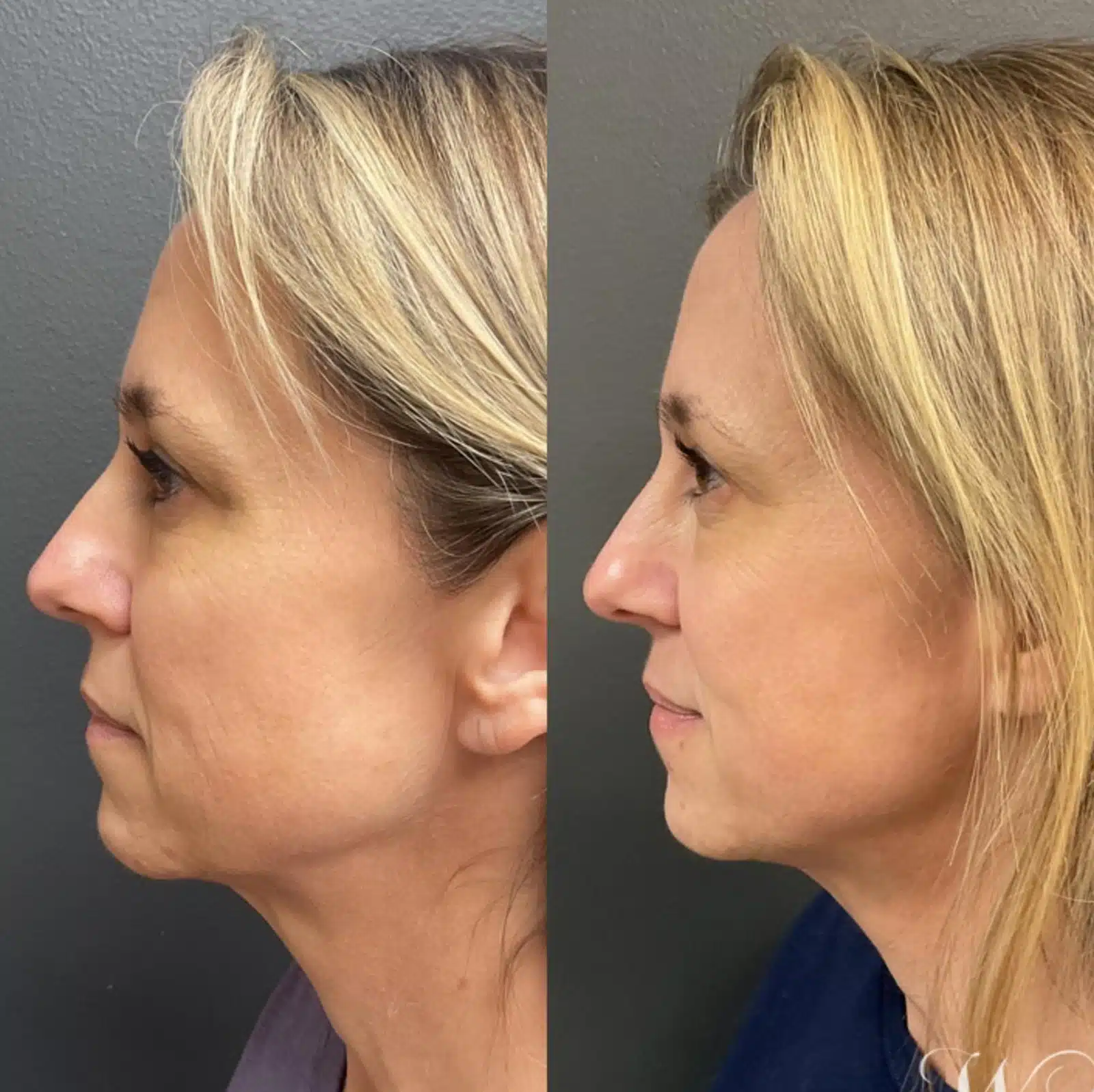 Mild redness or swelling